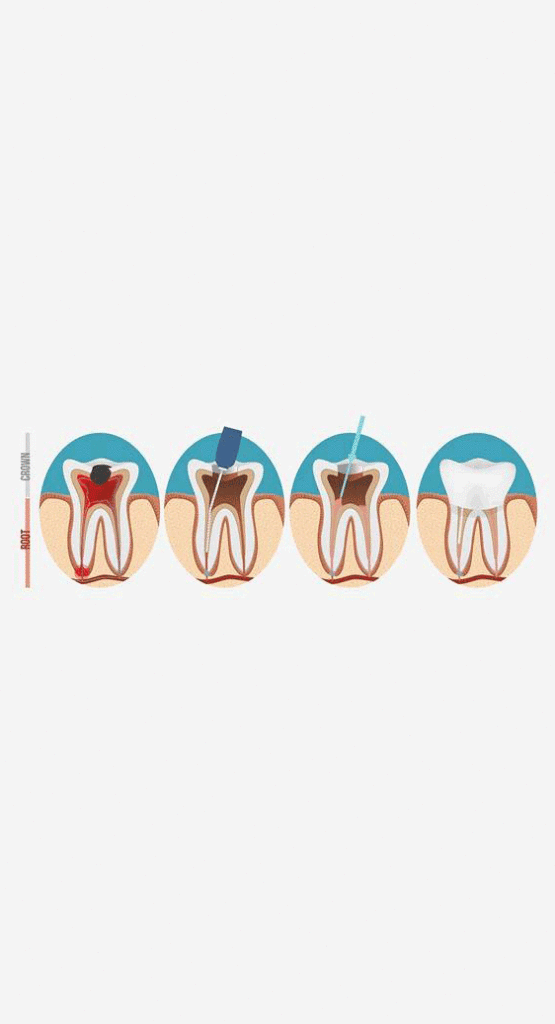 Comment se déroule un traitement endodontique ,